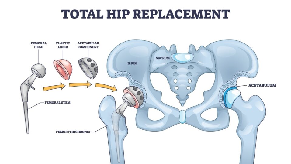 total hip replacement